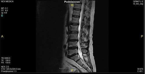 dyskopatia na zdjęciu rezonansu