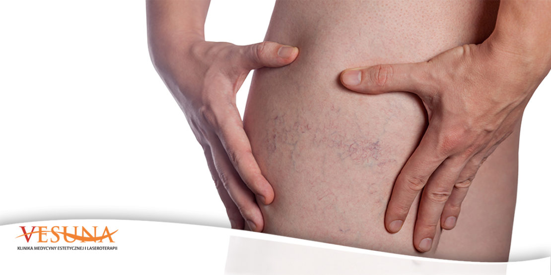 Blizny – ślady, o których chcemy zapomnieć